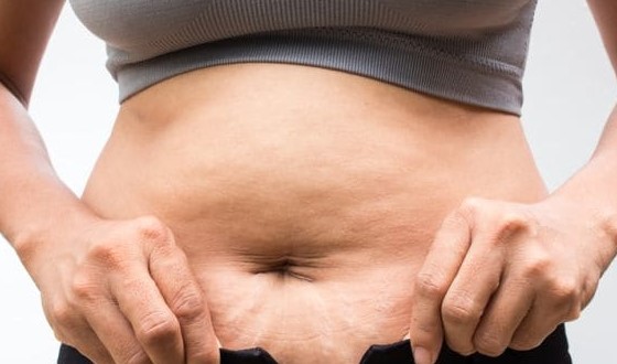 10 Stretch Mark Remedies That Actually Work #health