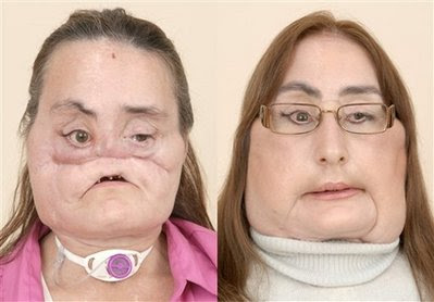 Face Transplant Surgery