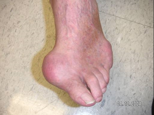 gout+Toe+Joint+with+Acute+Gout.jpg gout+Toe+Joint+with+Acute+Gout.jpg