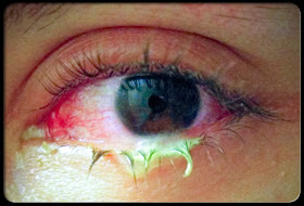12 common diseases of eye MEDICAL CHOICES