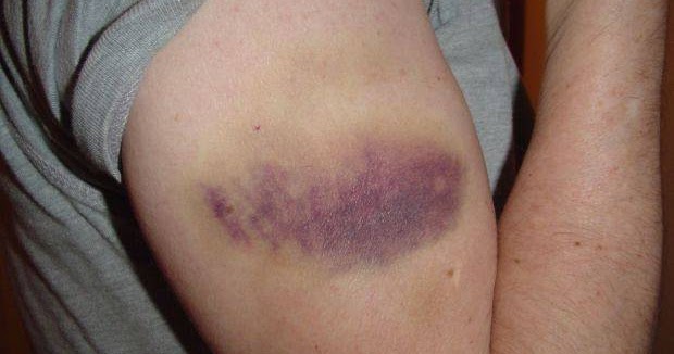 Healthy and Beauty Tips: How to Cure Bruises | Bruise ...