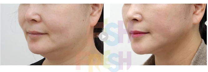 double chin liposuction before and after