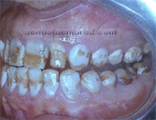 <Img src ="destrucción-superficie-dental-por-fluorosis-regional.jpg" width = "220" height "170" border = "0" alt = "Lesiones en esmalte por fluorosis.">