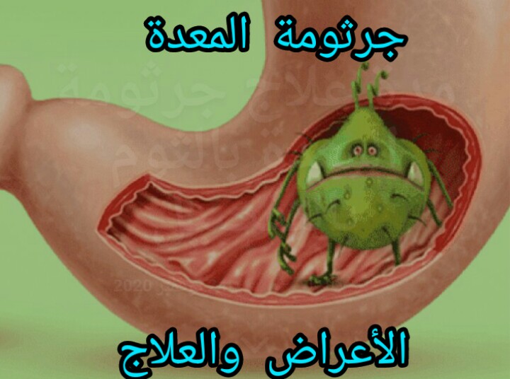 جرثومة المعدة