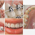 Các phương pháp niềng răng lệch lạc phổ biến