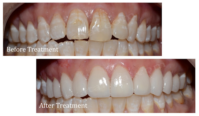 Before - After Images of Smile Design || Cosmetic Dental Treatment || Dr. Bharat Katarmal Dental Clinic