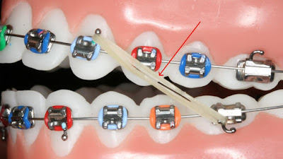 Niềng răng với hệ thống mắc cài tự buộc như thế nào?