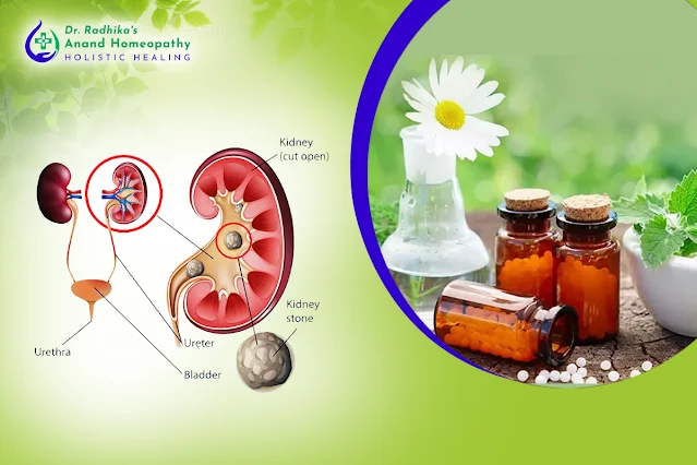 kidney stone treatment