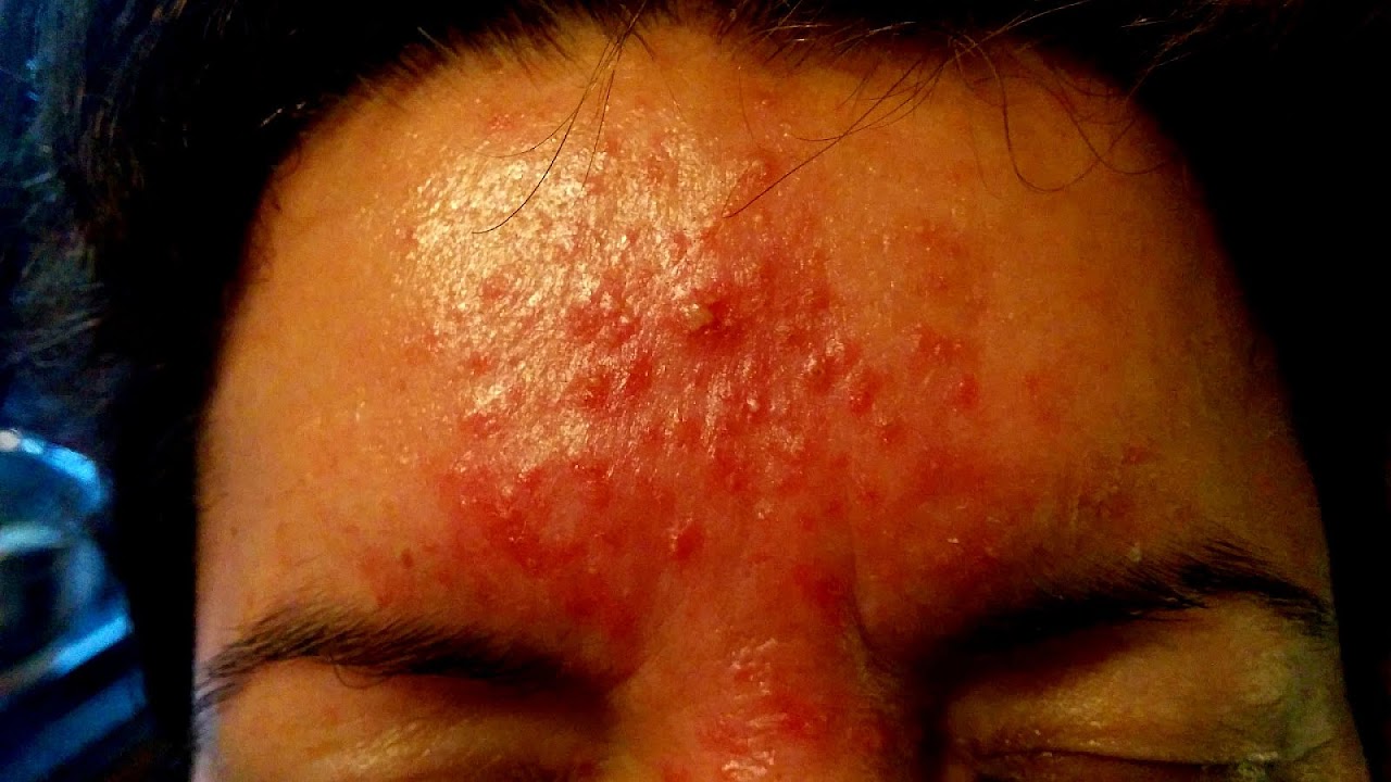 Allergic Reactions To Detergent Allergy