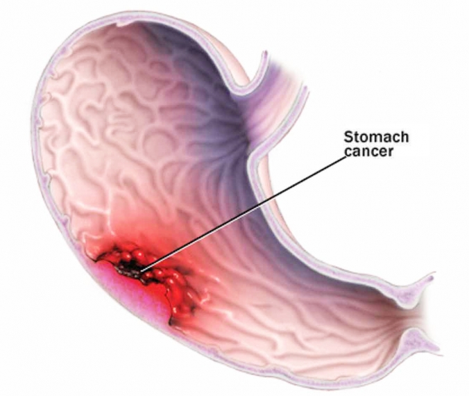 Macam Jenis Penyakit Lambung Yang Wajib Di Ketahui