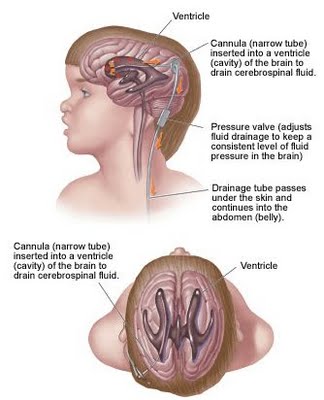 Pathophysiology of Hydrocephalus