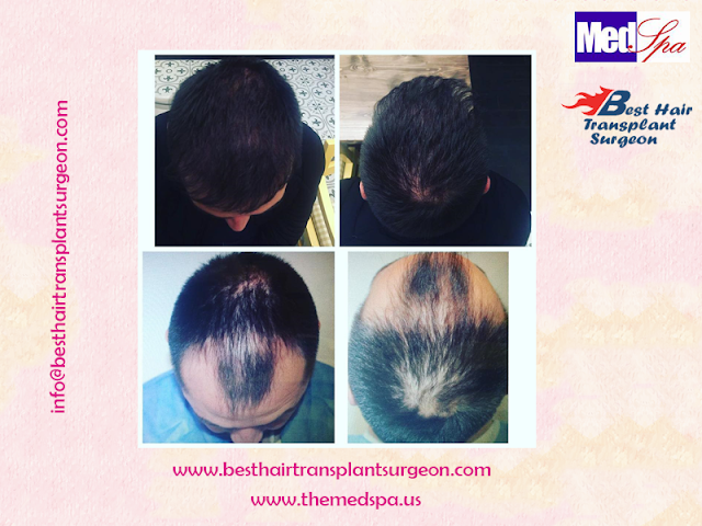 FUE Hair Transplant Surgery at MedSpa Clinic