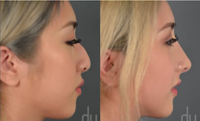 Korean Nose Job