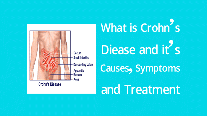 What is Crohn's disease