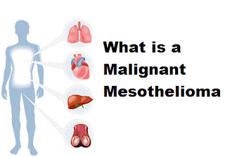 Malignant pleural mesothelioma