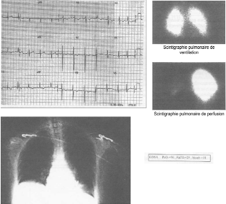 Dossier n°38 Corrigé de Cardiologie sur Une embolie pulmonaire