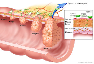 colon cancer treatment,colon cancer symptoms,colon cancer surgery