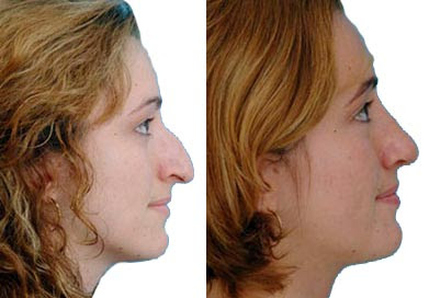 Nose Job Before And After