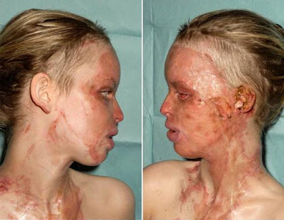 Katie Piper model after acid attack pictures