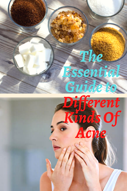 THE ESSENTIAL GUIDE TO DIFFERENT KINDS OF ACNE