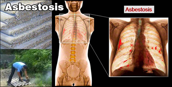 Treatment of Asbestosis in Ayurveda, Ayurvedic Treatment for Asbestosis