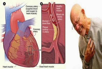 Cara Cepat Menyembuhkan Penyakit Jantung Koroner