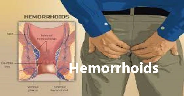 Hemorrhoids-What is the main cause of hemorrhoids?
