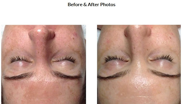Microneedling Before and After Treatment Photos
