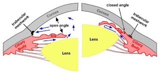 Open Angle Glaucoma