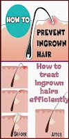 How to Properly Remove Ingrown Hair ?