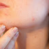 What Are The Causes Of Acne And Pimples?