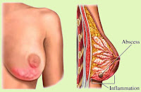 INFEKSI PAYUDARA KOMPLIKASI NIFAS