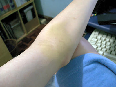 Painful bruise....ouchie wawa!