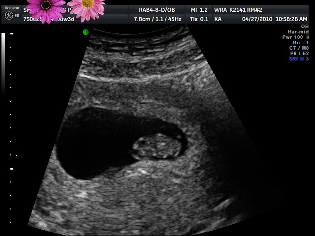 sonogram 5 weeks. pictures 12 5 week ultrasound.