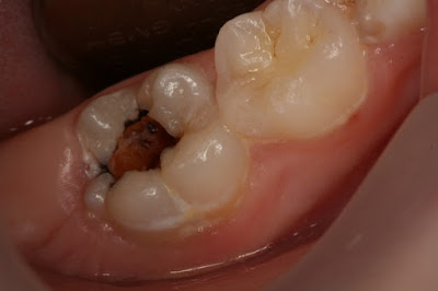 Nguyên nhân gây sâu răng hàm trên