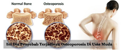 Benarkah Osteoporosis Bisa Terjadi Di Usia Muda?