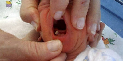 Baby With A Huge Tooth