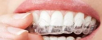 9 things you need to know if you want to wear invisible braces