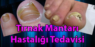 Tırnak Mantarı Hastalığı Tedavisi