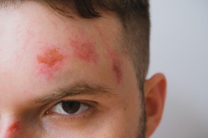 Shingles on the Face and Head