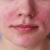 What Is Rosacea On The Face And How To Get Rid Of It?