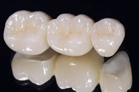 Bọc răng sứ cho răng