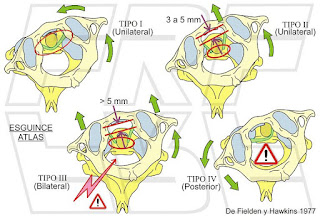 Tipos de esguinces entre el atlas y el axis.