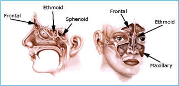 sinus stress headache from climate