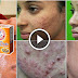 She Rub This Ingredients On The Face And Eliminate Acne Within A Few Days!