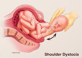 [shoulder_dystocia.jpg]