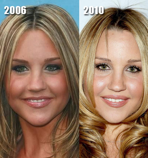 jennifer aniston surgery before after. Amanda Bynes Before and After