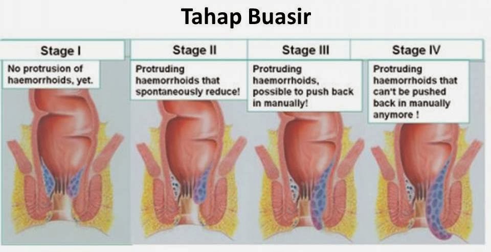 Vitamin Untuk Merawat Buasir  beyond ordinary health & beauty