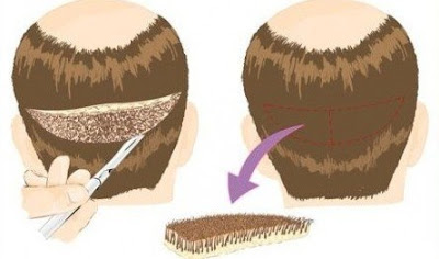 Hair transplant in Navi Mumbai