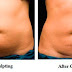 Cryolipolysis - Coolsculpting Technology